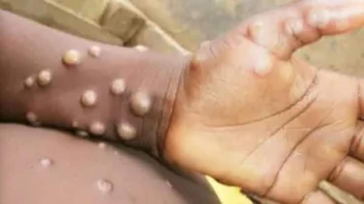 STAY SAFE: MPOX spreads across Nigeria